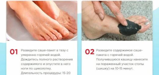ORTHOFIX Средство от вальгуса